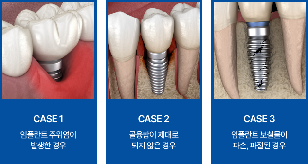 임플란트 재수술